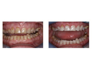 Before and After Teeth Whitening