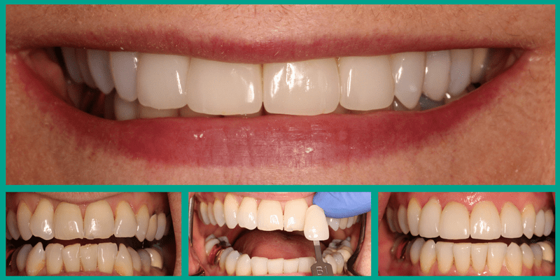 Before and after photos of Invisalign treatment of Dr. Curalli's mom.