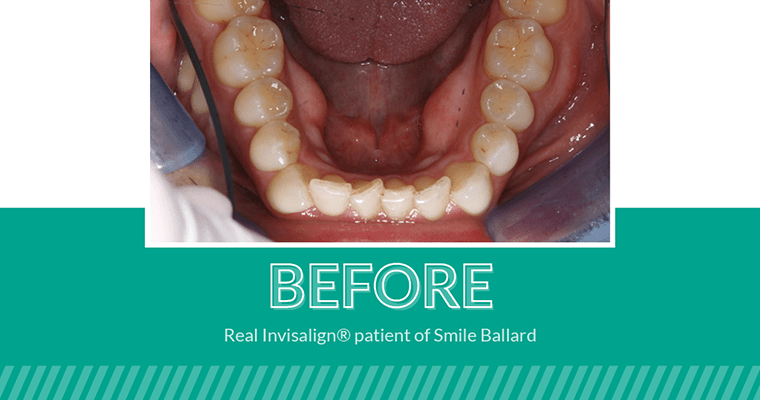 Real Invisalign patient of Smile Ballard before photo