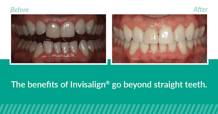 Invisalign before and after photos with text, "The benefits of Invisalign® go beyond straight teeth."