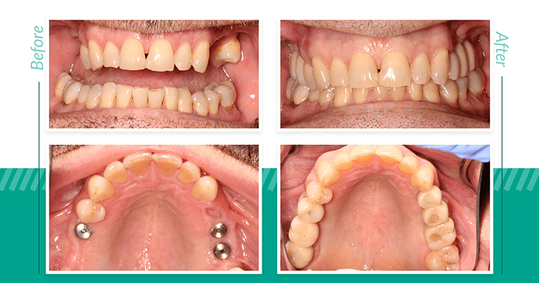 Before and after photos of dental implants by dentist at Smile Ballard in Seattle, WA