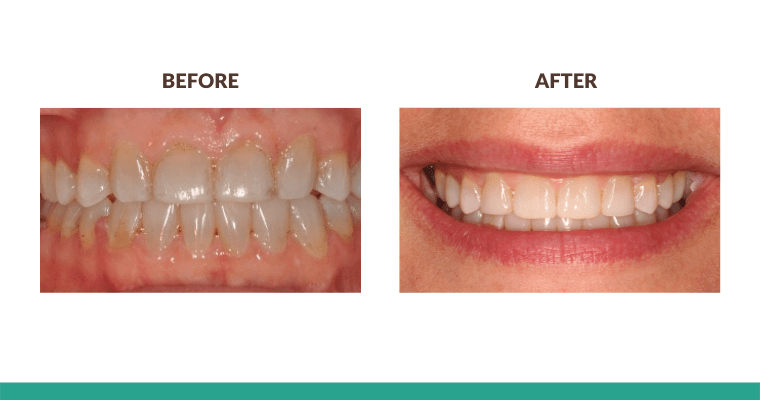 Two images showing before and after dental work
