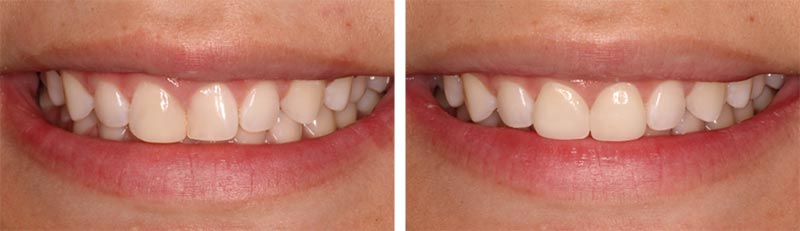 Real patient before and after photo of porcelain veneers in Seattle, WA.