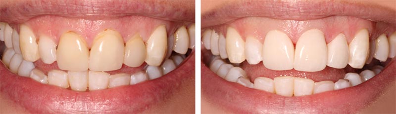 Before and after photo of a patient's smile