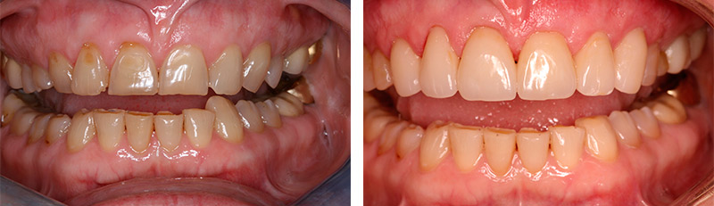 2 photos showing before and after dental work