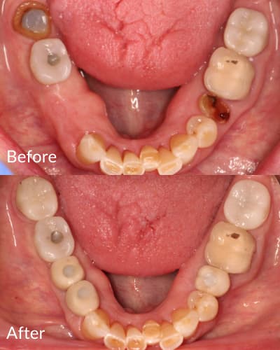 Before and after case of dental implants
