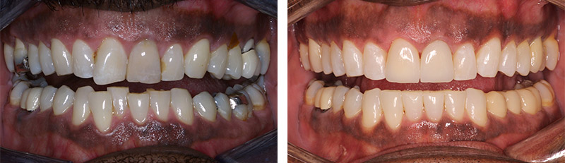 2 photos showing before and after dental work