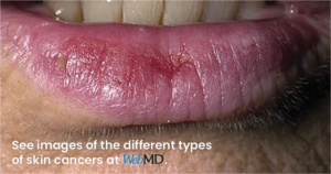 Image of a lip with abnormal skin changes.