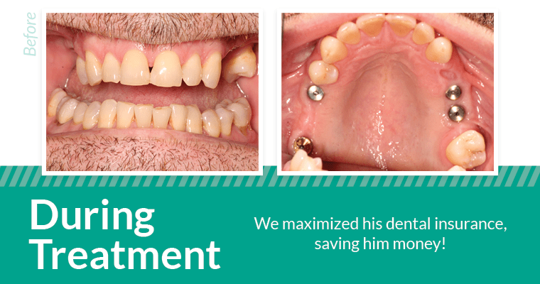 During dental implant treatment close up.