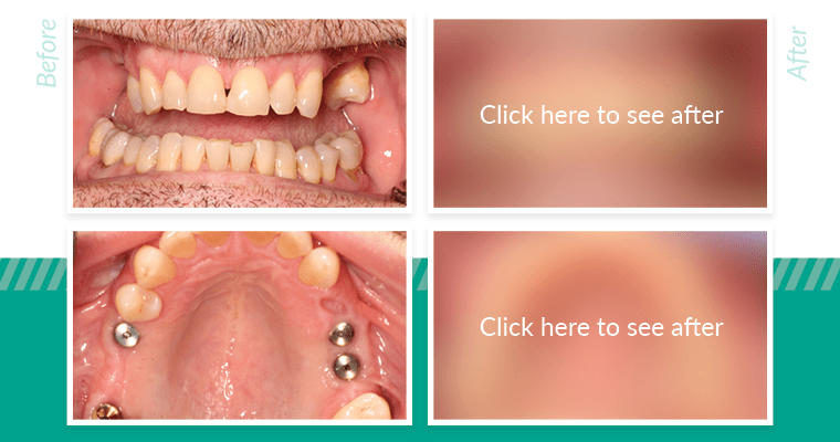 Image of a patient's mouth getting dental implants.